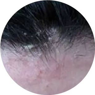 Dermatitis seborrheica: droogheid, rode huid en/of bloeding