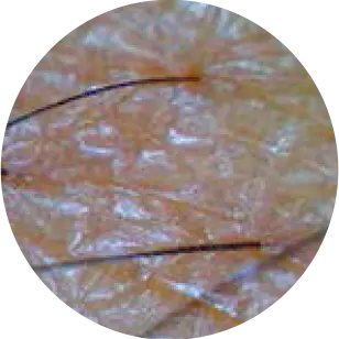 Haaruitval door de aanwezigheid van dermatitis of overgevoeligheid